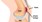 What is Patellofemoral Pain Syndrome - Essendon Physio Group Explains