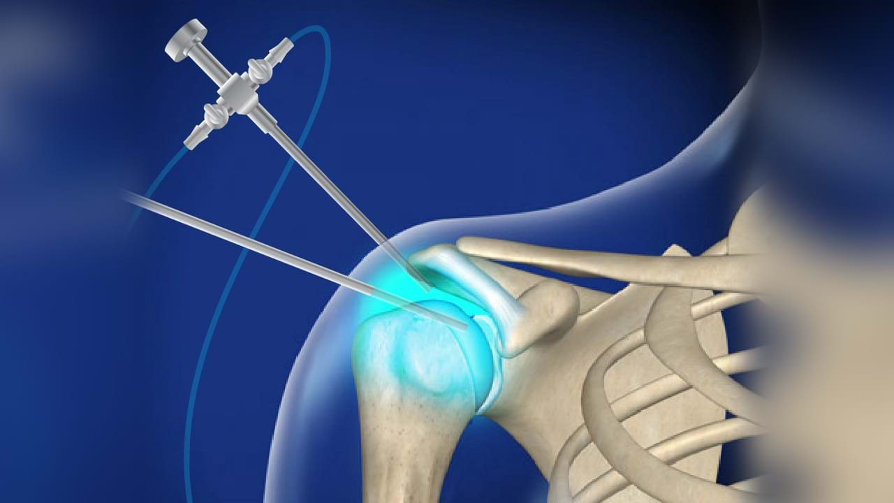 What is a Shoulder Arthroscopy?